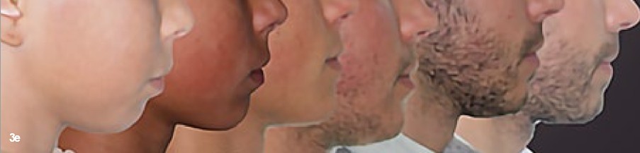Solving sagittal discrepancies in orthodontics is probably the most energy-demanding movement you can do with aligners